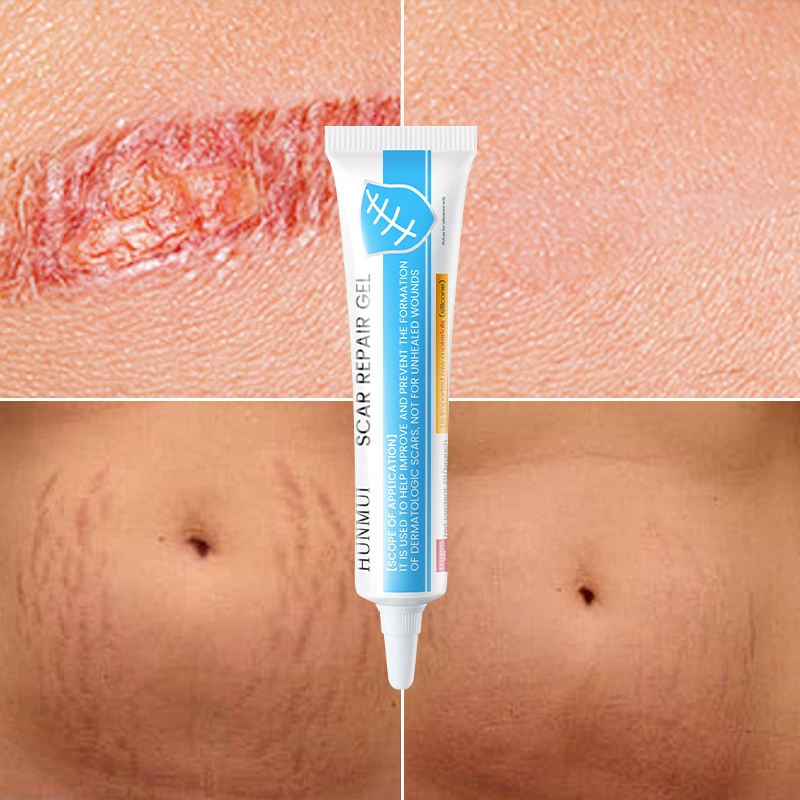 High Quality Skin Repairing Gel Natural Acne Pimple Mark Stretch Marks Scar Removing Cream